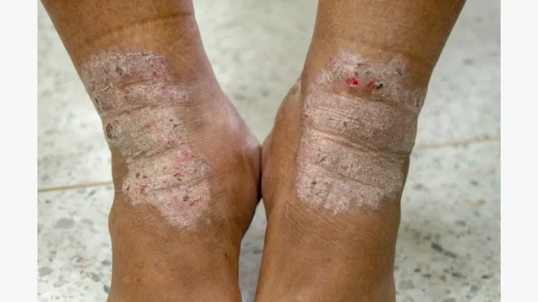 Atopic-dermatitis-on-darker-skin-body2