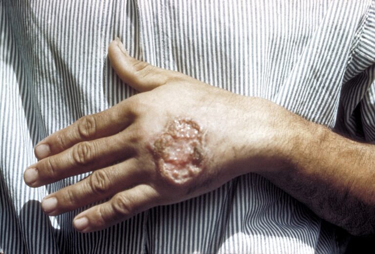 Skin_ulcer_due_to_leishmaniasis,_hand_of_Central_American_adult_3MG0037_lores