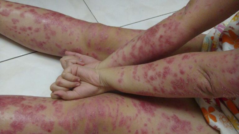 pejuang-psoriasis-3_169