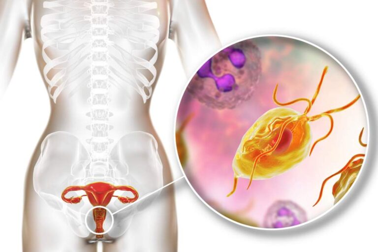 trikomoniasis