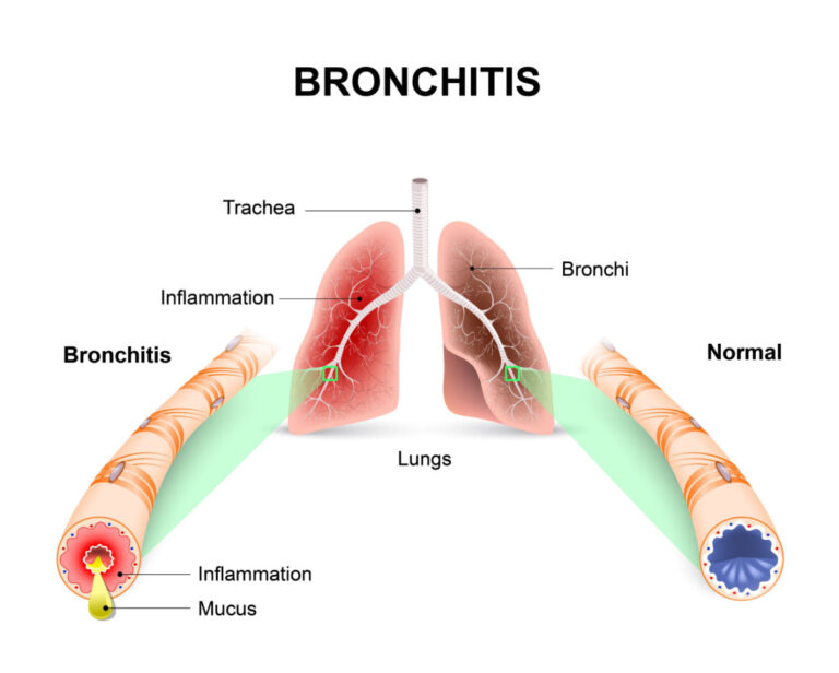 5-tanda-penyakit-bronkitis-yang-perlu-diwaspadai