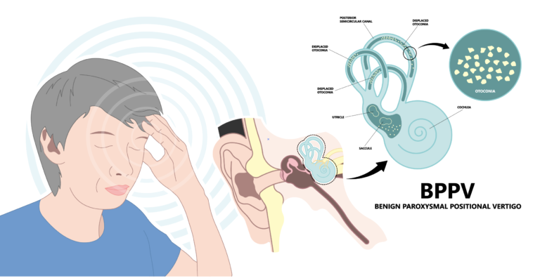 BPPV-4