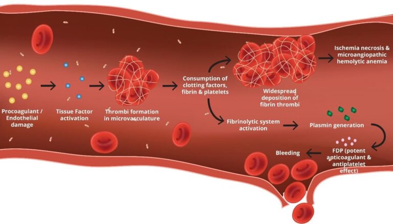 DIC-pathophysiology