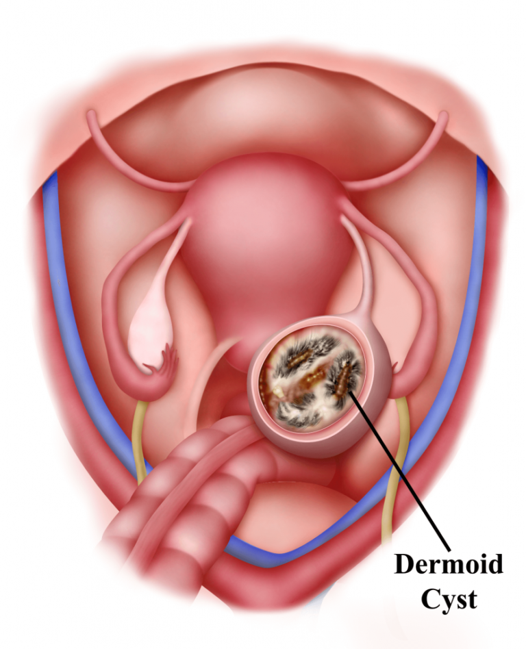 Figure-5.4-Dermoid-cyst-830x1024
