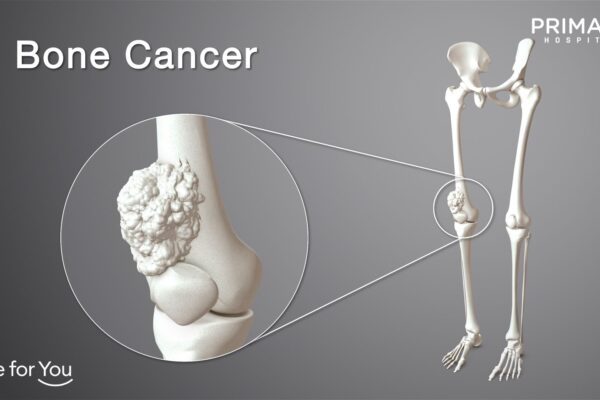 Tumor Tulang: Apa yang Perlu Diketahui