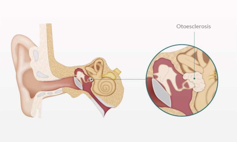Otosklerosis-Pertumbuhan-Tulang-Abnormal-di-Dalam-Telinga