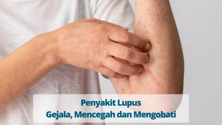 Penyakit-Lupus-Gejala-Mencegah-dan-Mengobati.jpg