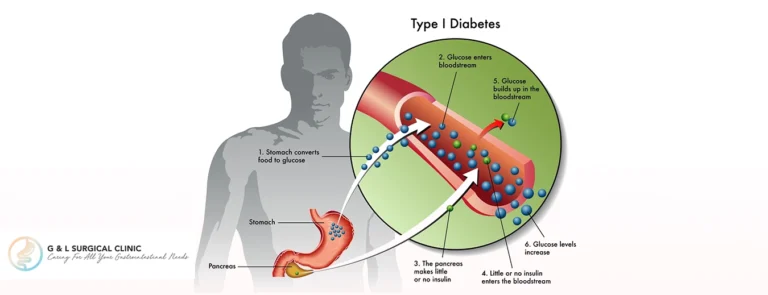 Type-1-Diabetes