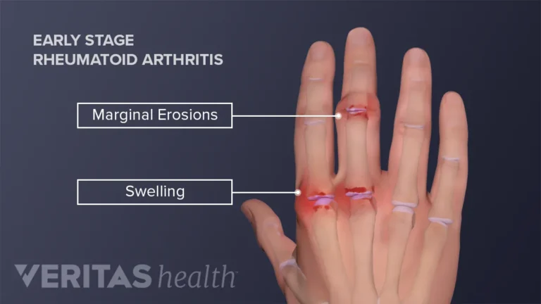 adult-hand-ra-early-stage-fingers