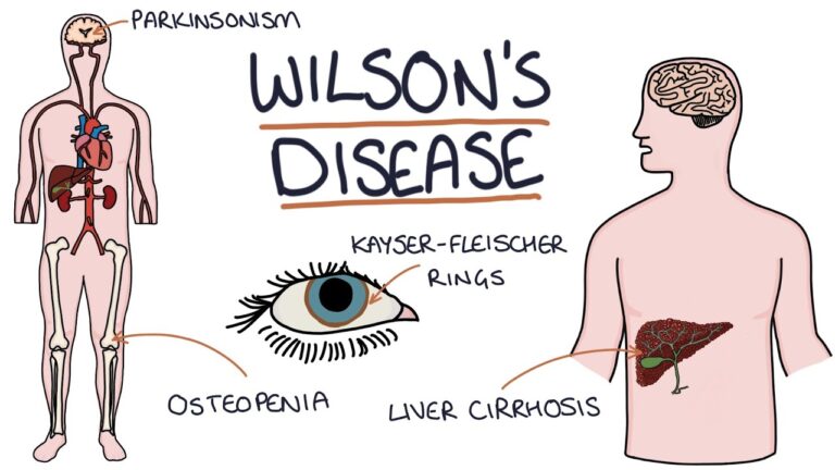 Wilson’s Disease: Penyakit Genetik yang Mempengaruhi Pengolahan Tembaga