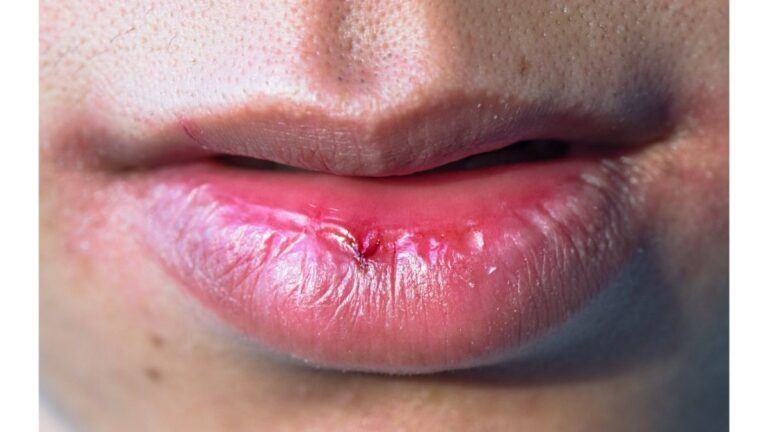 020887500_1616408987-Tanda-dan-Gejala-Kanker-Bibir-yang-Mesti-Anda-Waspadai-by-FroYo_92-Canva