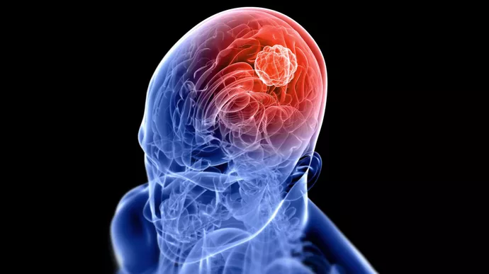 027009700_1568707219-Waspadai-_X_-Gejala-Tumor-Otak-yang-Diam-diam-Menyerang-By-Sebastian-Kaulitzki-Shutterstock