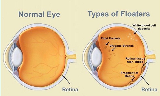 1_Eye-Floaters-
