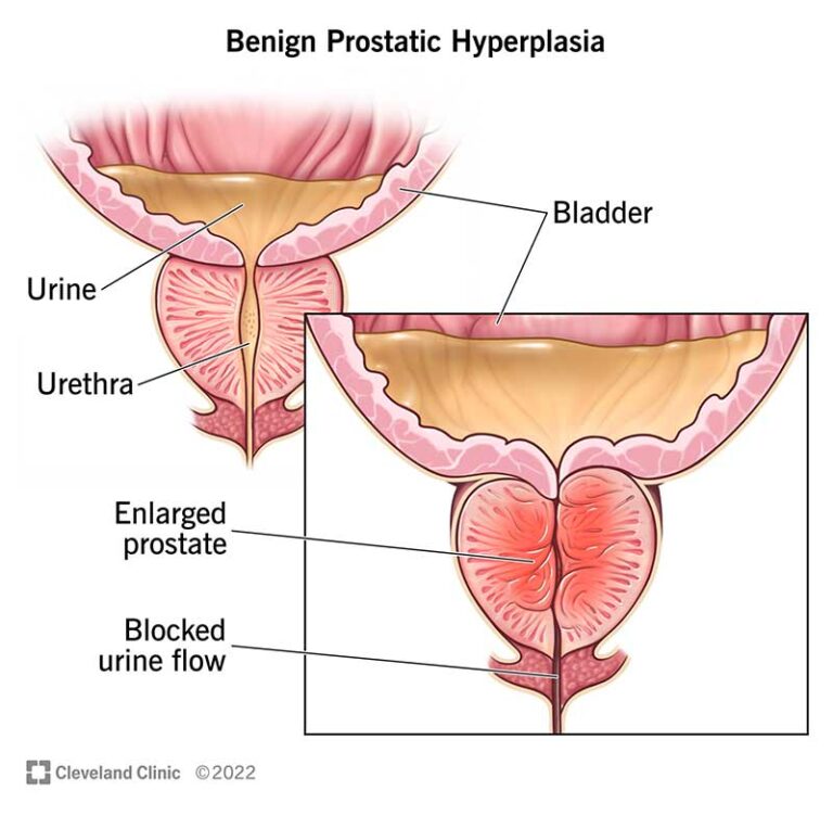 9100-benign-prostatic-hyperplasia