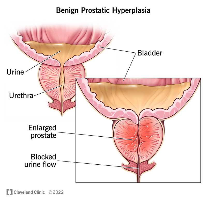 9100-benign-prostatic-hyperplasia