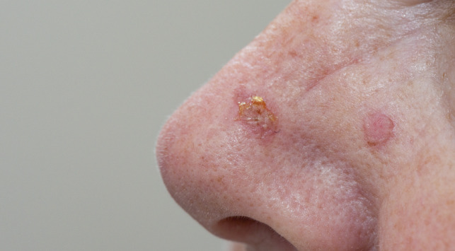 Actinic-Keratosis