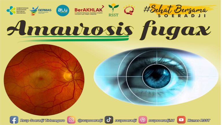 Amaurosis-fugax