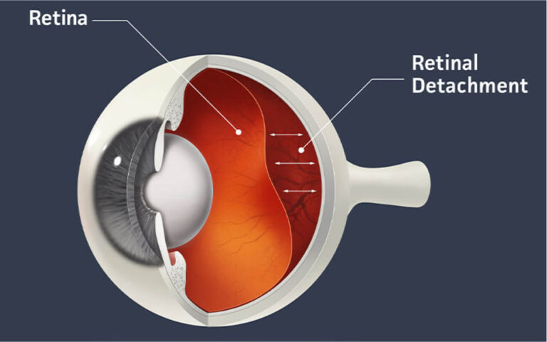 Artikel_Ablasio-Retina-Definisi-Penyebab-Gejala-dan-Pengobatan-1