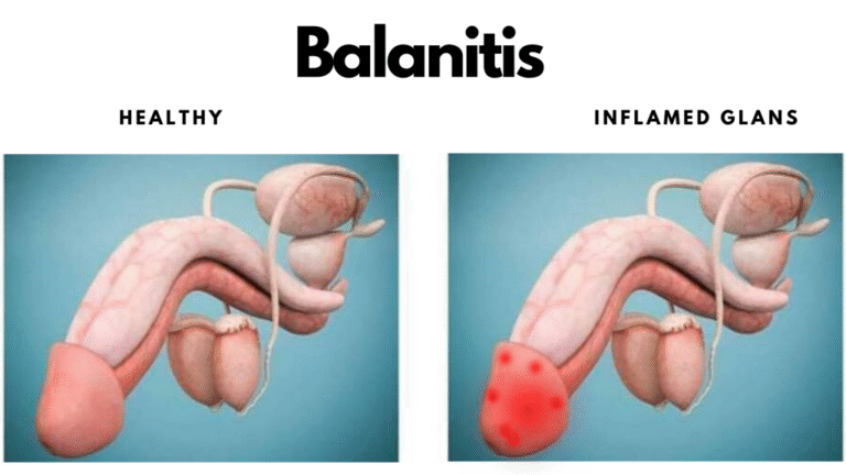 Balanitis-or-Balanoposthitis-1-1024x576
