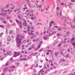 Choriocarcinoma_-2-_very_high_mag