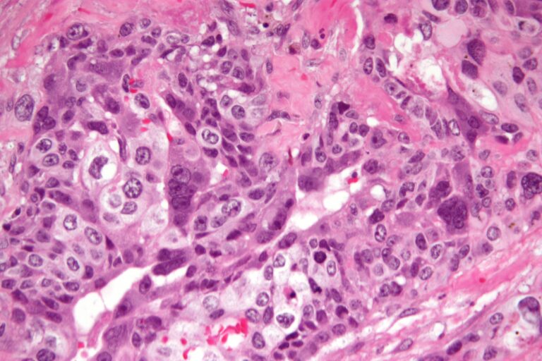 Choriocarcinoma_-2-_very_high_mag