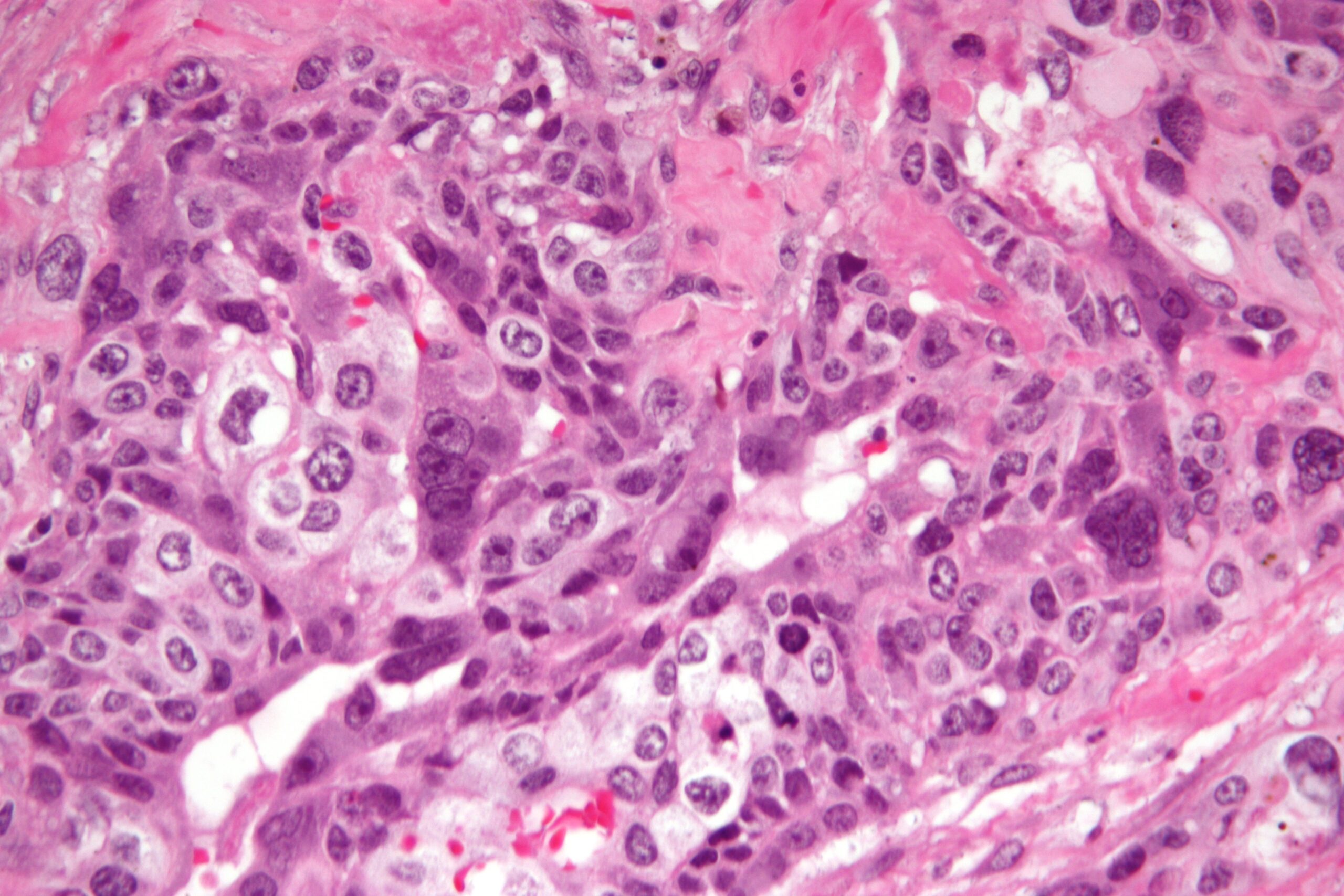 Choriocarcinoma_-2-_very_high_mag