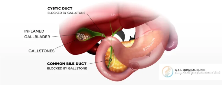 Cystic-Duct-Block