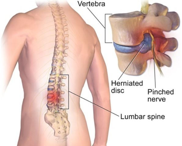 Flexfree_Clinic_Saraf_Kejepit_akibat_Hernia_Nukleus_Pulposus__HNP__a6JJo