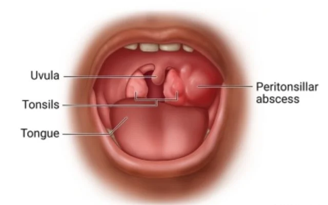 JonH0_Abses-Peritonsiler
