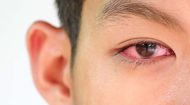 Konjungtivitis