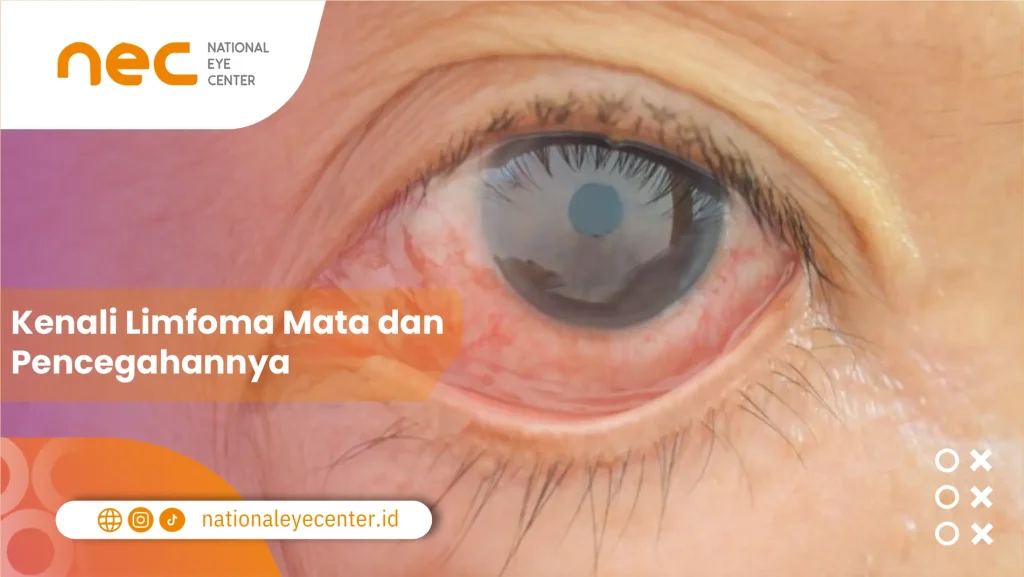 Limfoma-Mata-1024x577