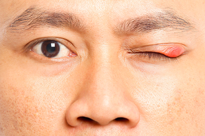 Waspada-Penyebab-Tumor-Kelopak-Mata