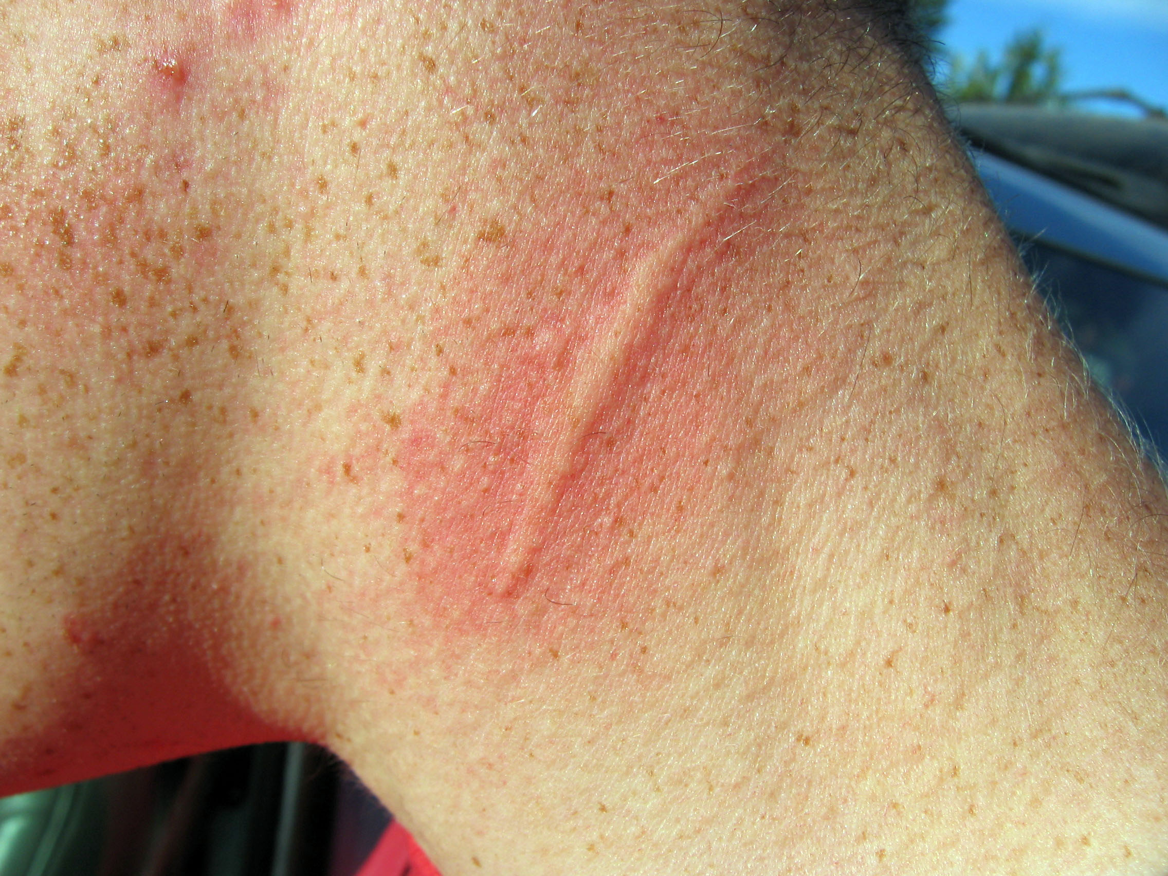 Welt_on_wrist