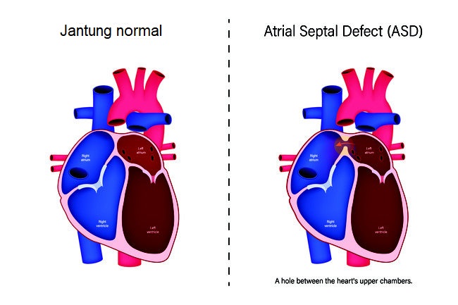 atrial-septal-defect