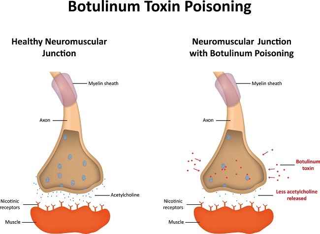 botulisme-0-alomedika