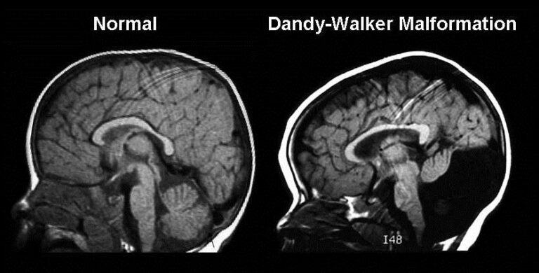 dandy-Walker-1