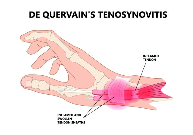 de-quarvains-tenosynovitis