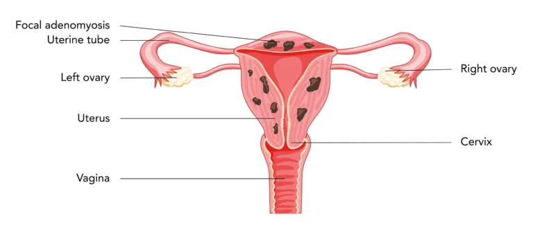 gleneagles-adenomyosis