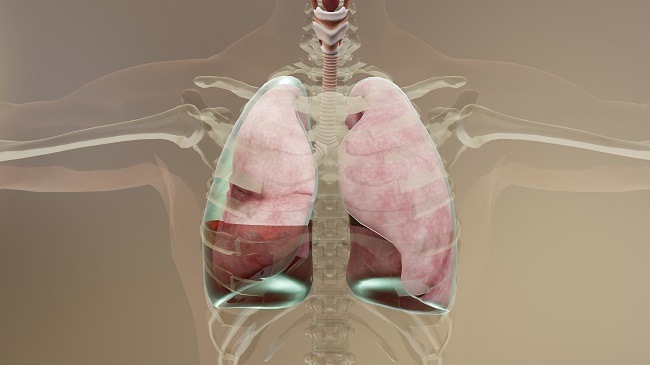 hemothorax