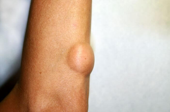 kenali-x-tanda-lipoma