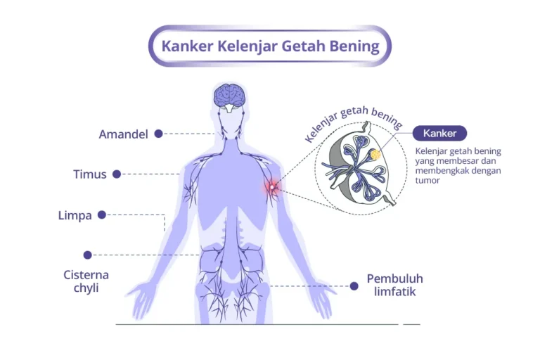 pcc_hodgkin_lymph_bm