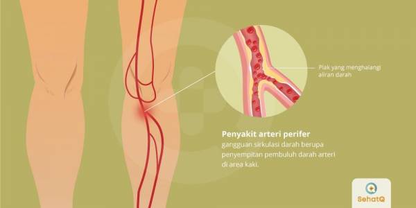 penyakit-arteri-perifer-68