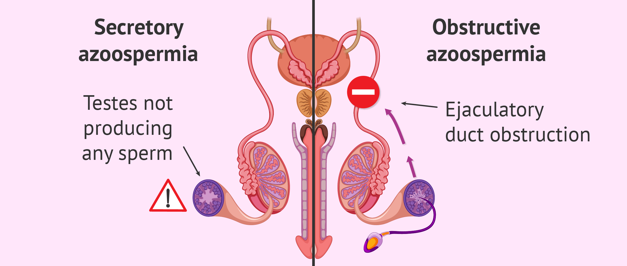 secreting-or-non-obstructive-azoospermia