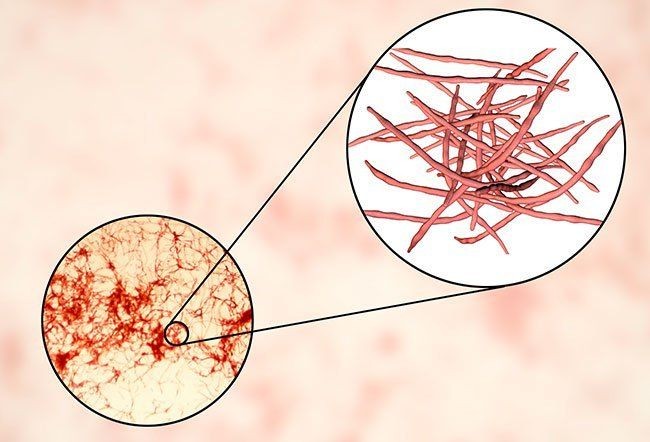what-causes-actinomycosis-bcd503fbc7f4910c43c816e5d73ea1ff