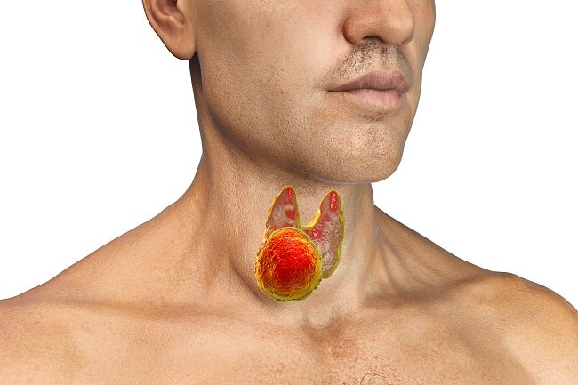 kesehatan-dan-gejala-toxic-adenoma-tiroid-yang-perlu-diketahui
