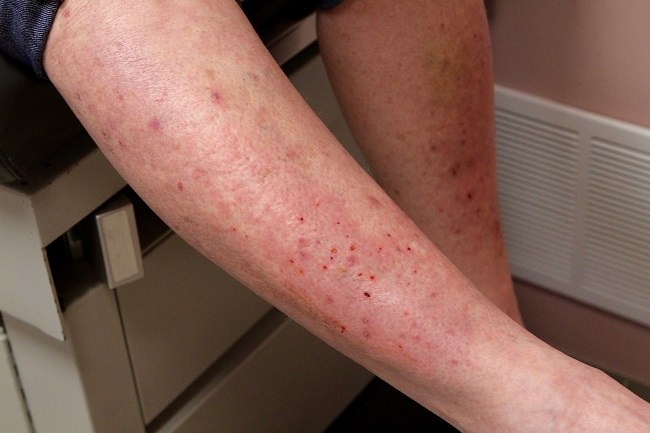 kesehatan-dermatitis-herpetiformis-gejala-penyebab-dan-pengobatan