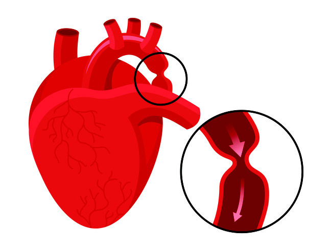 kesehatan-koarktasi-aorta-penyebab-gejala-dan-penanganannya