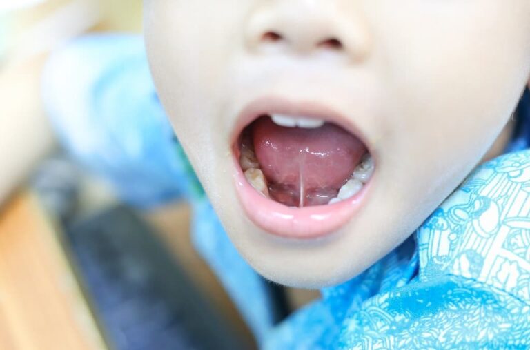 kesehatan-tongue-tie-ankyloglossia-penyebab-gejala-dan-penanganan