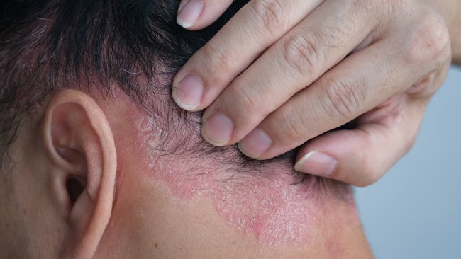 memahami-gejala-dan-penanganan-dermatitis-seboroik-pada-kulit