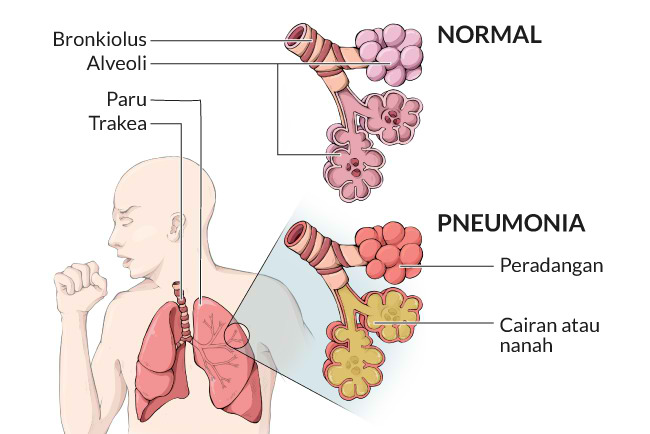 memahami-gejala-dan-pencegahan-penyakit-pneumonia